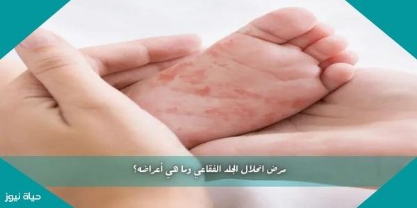 مرض انحلال الجلد الفقاعي وما هي أعراضه؟