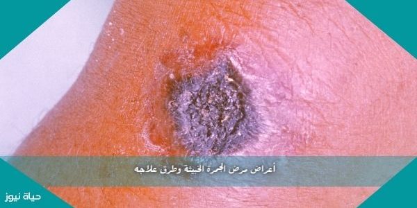 أعراض مرض الجمرة الخبيثة وطرق علاجه
