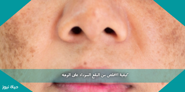 كيفية التخلص من البقع السوداء على الوجه