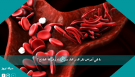 ما هي أعراض فقر الدم الحاد عند النساء وطريقة العلاج ؟