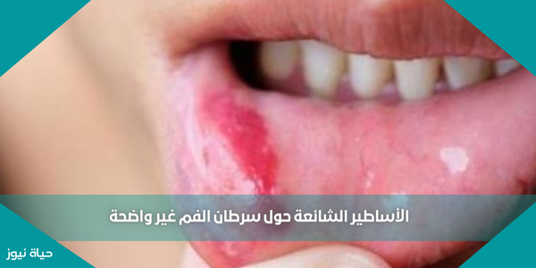 الأساطير الشائعة حول سرطان الفم غير واضحة