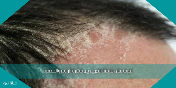 تعرف على طريقة التمييز بين قشرة الرأس والصدفية