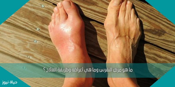 ما هو مرض النقرس وما هي أعراضه وطريقة العلاج ؟